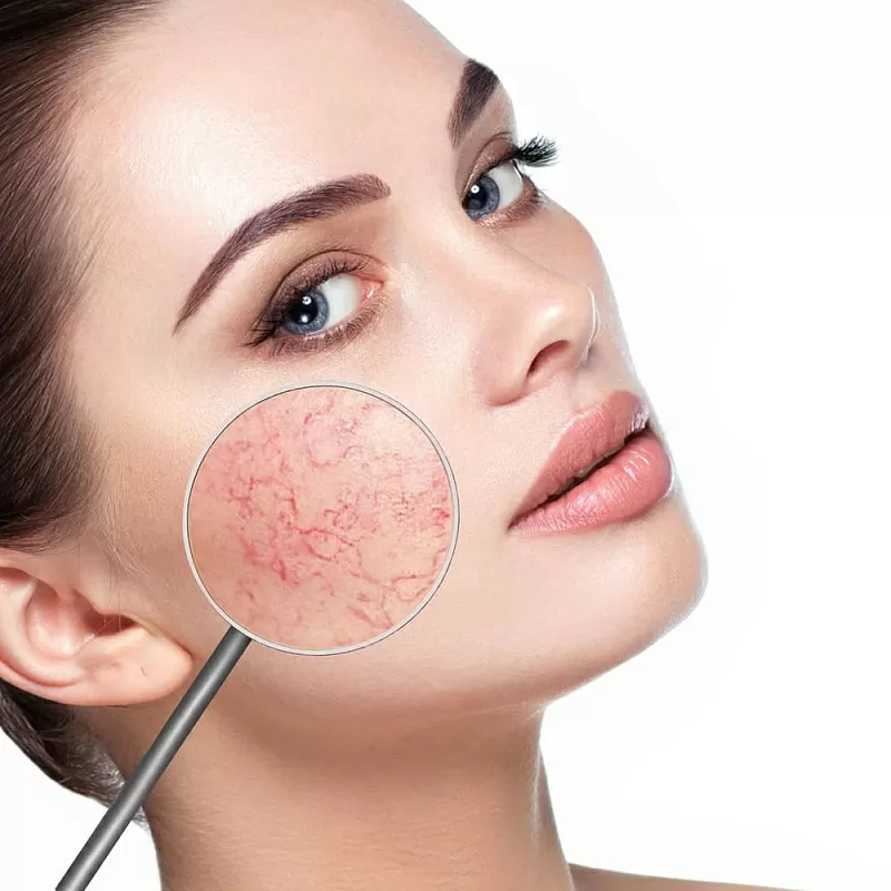 Reviderm Couperose therapy cream