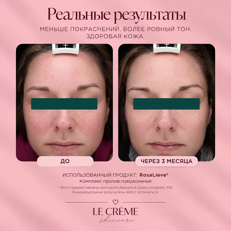 Marini SkinSolutions Rosalieve
