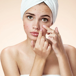 Как лечить акне на лице: особенности